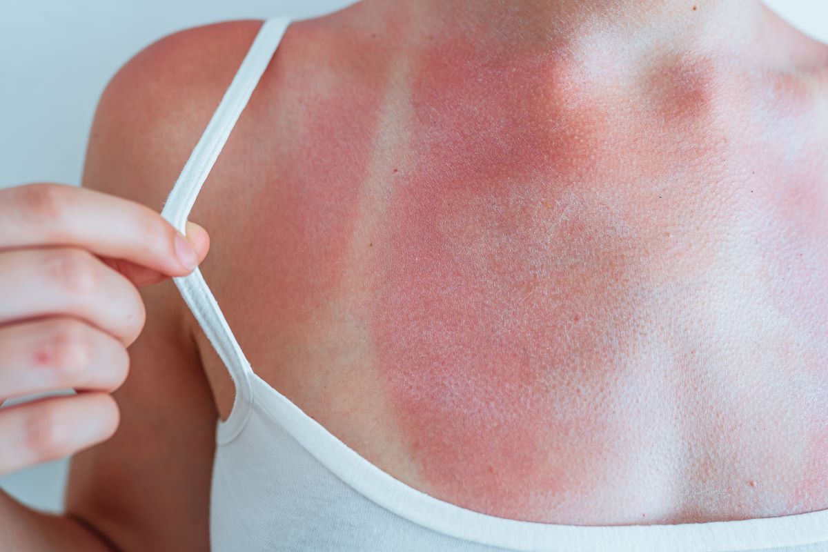 Sonnenbrand im Ortenaukreis: Vermeiden, behandeln und ernst 